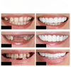 Smart Smile - Dientes de prótesis provisionales reutilizables